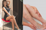 Siêu mẫu bị gù lưng, giãn tĩnh mạch vì một kiểu ngồi ai cũng nghĩ là duyên dáng