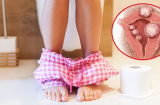 Đi vệ sinh ra khối u xơ tử cung dài 10 cm: Cô giáo hối hận vì bỏ qua dấu hiệu cảnh báo sớm