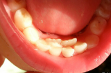 Con kêu đau răng mẹ cho đi khám thấy vật thể lạ xuất hiện