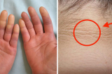 7 dấu hiệu trên da báo hiệu bệnh tiểu đường, thấy nổi mụn bất thường hãy cảnh giác