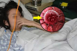 1/6 bệnh nhân mắc ung thư đều do viêm: 5 vị trí trên Sh88bet đăng ký miễn phí bị viêm cảnh báo ung thư đang đến gần