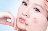 Chăm sóc da toàn diện bằng bí đỏ xóa tan nỗi lo lão hóa, mụn nhọt