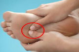 7 dấu hiệu ở bàn chân cảnh báo Sh88bet đăng ký miễn phí đang gặp nguy, cần chú ý nhất lá gan