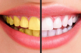 8 cách làm trắng răng tự nhiên đơn giản ngay tại nhà