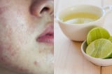 6 thứ tàn phá Mừng SHBET phiên bản mới 2025 nhanh không kém corticoid hay rượu thuốc, tuyệt đối không được dùng để bôi lên mặt