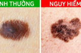 5 biến đổi bất thường của nốt ruồi cảnh báo khối u ác tính đang phát triển, cần đi khám gấp