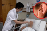 Người phụ nữ bị áp se não suýt mất mạng vì để nước vào tai khi gội đầu: BS cảnh báo đừng chủ quan
