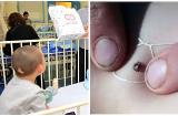 Nhìn kĩ 'nốt ruồi' ở lưng con 'đang cử động: Mẹ hốt hoảng đưa đi viện, có người đã qua đời vì bị cắn