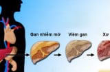 2 thói quen xấu vào buổi sáng phá nát gan hơn uống rượu: Đáng tiếc toàn là 'vấn đề chung'