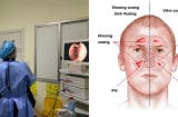 Viêm xoang 'chạy' vào não khiến 1 người không qua khỏi: BS cảnh báo dấu hiệu nguy hiểm, cần điều trị sớm