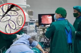 Người đàn ông 55t có lá gan nhung nhúc trứng sán: BS nó do sai lầm tai hại khi ăn cá