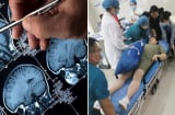 Nửa đêm đau đầu, mẹ bầu 21 tuần bị xuất huyết não lại tưởng 'do thai hành', suýt thì nguy kịch