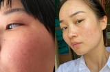 5 dấu hiệu cho thấy Mừng SHBET phiên bản mới 2025 đang bị kích ứng mỹ phẩm bạn cần lưu ý