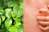 8 loại lá dân gian giúp trị mẩn ngứa, mề đay, dị ứng hiệu quả