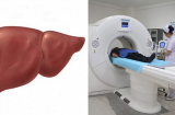 5 điểm chung thường có trong khi ngủ ở những người gan kém, 'dính' 3/5 là bệnh rất nặng rồi
