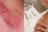 3 mẹ con lần lượt phát hiện nhiễm HPV, nguyên nhân không đâu xa là do vật dụng thường dùng trong nhà tắm