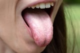 Lưỡi có 1 trong 5 biểu hiện sau là dấu hiệu của bệnh: Thấy lưỡi chuyển vàng, tím phải coi chừng