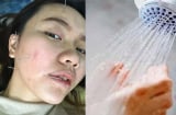 Cô gái 26t bị liệt dây thần kinh số 7, nửa mặt cứng đờ vì thói quen tai hại nhiều người trẻ mắc phải