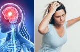 Giám đốc đột quỵ ở tuổi 30: Bác sĩ cảnh báo '6 nhóm người có nguy cơ đột quỵ cao hơn bình thường'