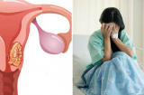 9 kiểu phụ nữ dễ bị K tử cung hơn bình thường: Tự kiểm tra tại nhà sẽ biết thôi