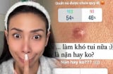 Võ Hoàng Yến trưng cầu ý kiến cư dân mạng về việc nặn mụn và nhận được kết quả bất ngờ
