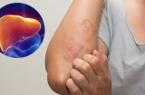 Cơ thể có '2 ngứa, 3 đen' chứng tỏ chức năng gan cực kỳ kém, hy vọng bạn không mắc dù chỉ một điểm