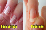 6 dấu hiệu ở móng tay cảnh báo bệnh nguy hiểm, đừng chủ quan lơ là kẻo hối hận