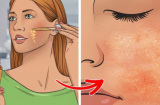 Bác sĩ da liễu cảnh báo: 5 sản phẩm tưởng tốt nhưng tàn phá da nghiêm trọng, càng dùng da càng xấu