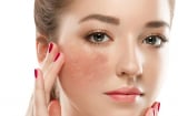 Gợi ý những cách loại bỏ đốm đen cho bạn Mừng SHBET phiên bản mới 2025 sáng mịn