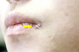 Nữ sinh 15 tuổi bị loét khóe miệng do nhiễm HPV dù chưa từng quan hệ: Bs nói do dùng chung 1 thứ đồ