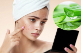Bật mí cách giúp hết thâm do mụn để lại trong vòng 1 tuần từ các nguyên liệu tự nhiên