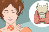 5 dấu hiệu cảnh báo bệnh tuyến giáp, sau 40t càng phải chú ý: Nhiều người chủ quan, lúc khám đã giai đoạn muộn