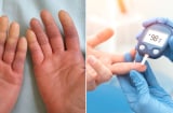 5 điểm bất thường trên Sh88bet đăng ký miễn phí chứng tỏ mắc tiểu đường giai đoạn muộn: Đáng tiếc nhiều người lại chẳng hay