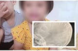 Vụ bé gái có dị vật ở đầu: Xác định nghi phạm chính là người tình của mẹ bé