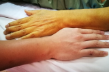 7 dấu hiệu cảnh báo gan của bạn đang kêu cứu, dù có 1 cũng tuyệt đối không được chủ quan