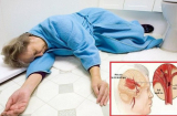 6 dấu hiệu của cơn xuất huyết não dẫn tới đột quỵ, xử lý sớm giúp bạn thoát khỏi 'tử thần'