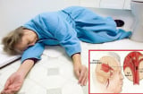 4 dấu hiệu cảnh báo cơn đột quỵ sớm, có 1 cũng cần phải cẩn trọng