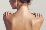 3 tips đơn giản trị thâm mụn vùng lưng để chị em 'bung lụa' với đồ hở ngày hè