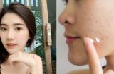 Bôi kem đánh răng có trị được mụn, da đẹp sáng mịn như lời đồn?
