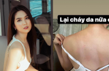Ngọc Trinh tiết lộ hình ảnh lưng bị cháy da đỏ rát, lý do khiến fan xót xa