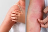 Cơ thể bị “ngứa ngáy” 2 chỗ này, 90% là biểu hiện của bệnh xơ gan: Bất ngờ khi biết thủ phạm