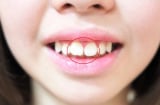 Các cụ dạy: 4 kiểu răng xấu phá tướng khiến tình - tiền lận đận, cuộc đời khốn khó