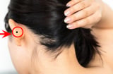 5 nốt ruồi tượng trưng cho Tài - Lộc - Phát: Có 1/5 là cực phẩm may mắn, hưởng lộc trọn đời
