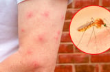 Cùng ở một chỗ, vì sao có người bị muỗi đốt nhiều, người thì không: Có phải do 'thơm thịt'?