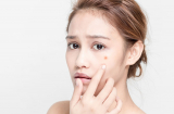 5 loại mụn chớ có dại mà đưa tay lên nặn kẻo nguy hiểm đến tính mạng