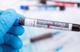 Bộ Y tế đề nghị giám sát chặt nguy cơ lây nhiễm virus Marburg vào Việt Nam