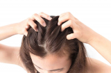 6 giải pháp cấp cứu tình trạng da đầu có mùi hôi gây khó chịu