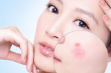 Nếu bạn có những thói quen này thì mụn sẽ đeo bám, thói quen thứ 4 rất nhiều người mắc