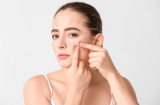 6 cách trị mụn từ trái cây hiệu quả sau 1 tuần chị em chần chừ gì nữa mà không triển ngay