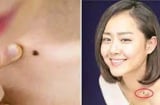 7 nốt ruồi quý hơn vàng, dù là nam hay nữ đều phát tài hơn người, càng già càng giàu có